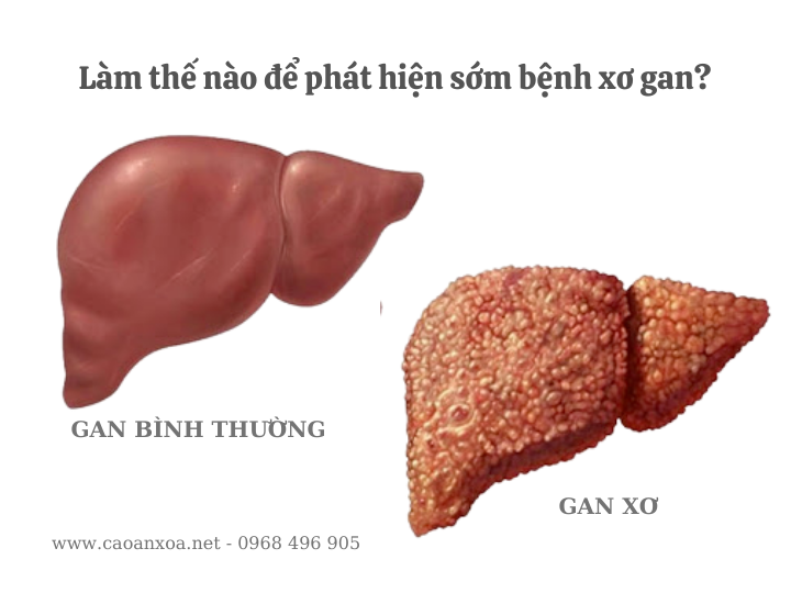 Nhận biết các giai đoạn của gan bình thường và gan bị xơ